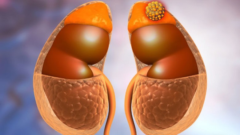The global adrenocortical carcinoma treatment market is expected to grow steadily over the forecast period