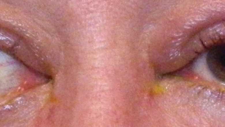 Thyroid eye disease is an autoimmune disorder that affects persons who have an overactive thyroid gland