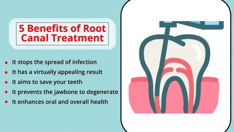 Benefits of Root Canal Treatment | Best Emergency Dentist Near You