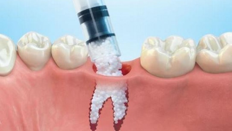 Tooth Regeneration Involves Stem Cell-Based Medicine Procedures, Which Are Regenerative and Is Used For Easy Replacement of Lost or Damaged Teeth