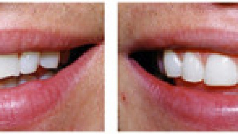 Prosthodontist and Cosmetic Dentist in Nokomis: Dr. Keith Blessitt - We Make Smiles