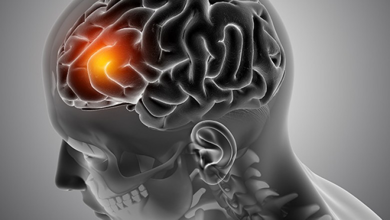 Brain Tumor: Debunking Myths & Misconceptions