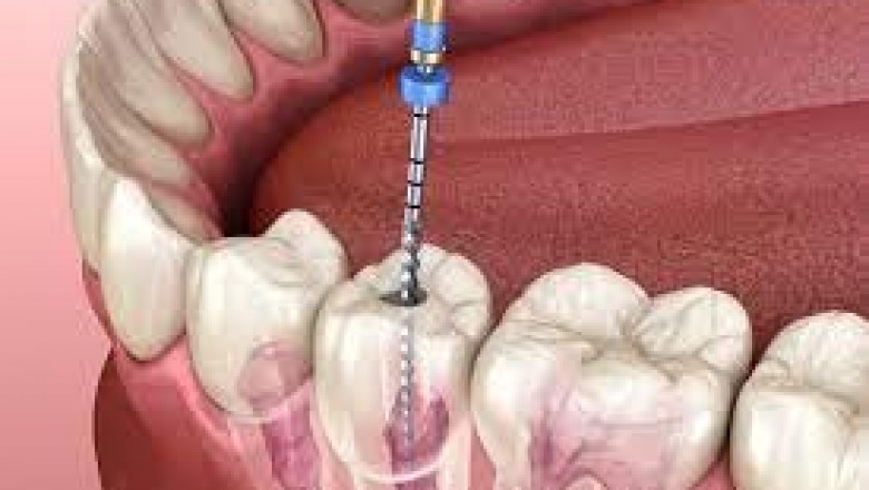 How to Prepare for Wisdom Teeth Removal?