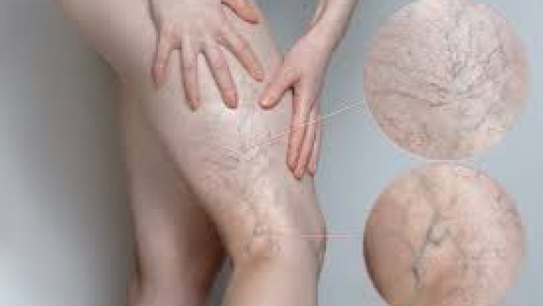How do you treat spider veins?