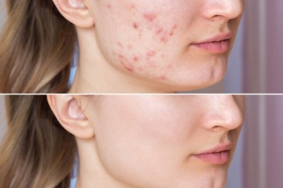 Melasma: Diagnosis and treatment - Dr. Jyoti Sharma
