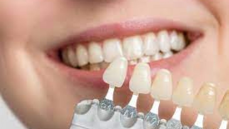 Are Veneers A Good Alternative To Getting The Beautiful Smile?