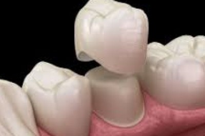 Dental Crowns: Types of Caps, Uses, Lifespan, and Cost