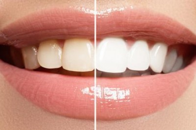 FAQ (Frequently Asked Questions) About Porcelain Veneers:
