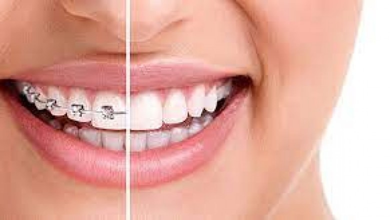 Orthodontist: How To Find The Finest Teeth Alignment Service?