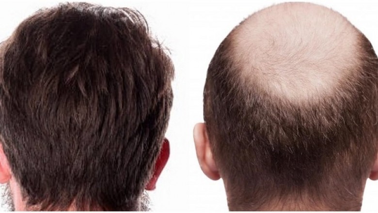 What Happens To Transplanted Hair?