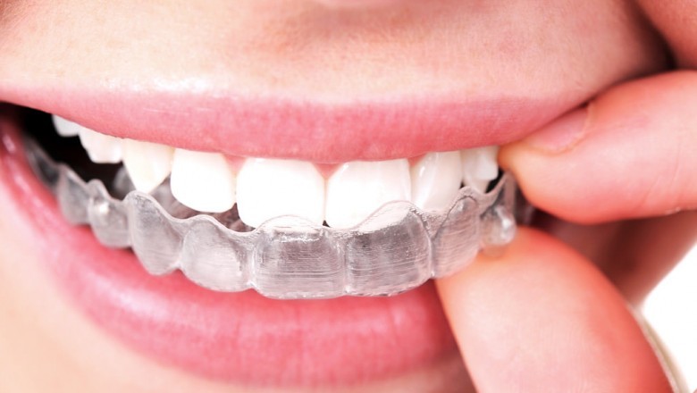 Can you have braces after the age of 21?