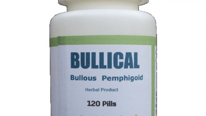 Treatment for Alopecia | Remedies | Herbal Care Products