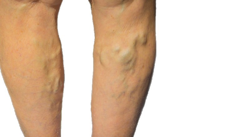 Vein Treatment: Choose The Suitable One For You.