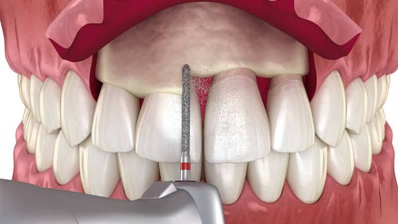 Why Require A Crown Lengthening Procedure?