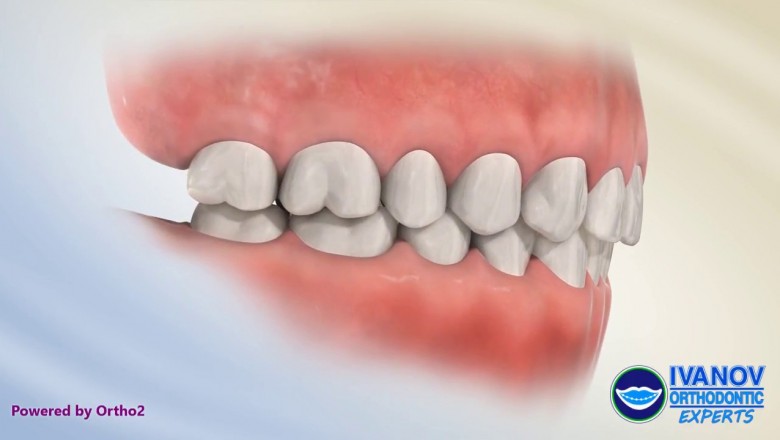 Advantages of teeth alignment and braces