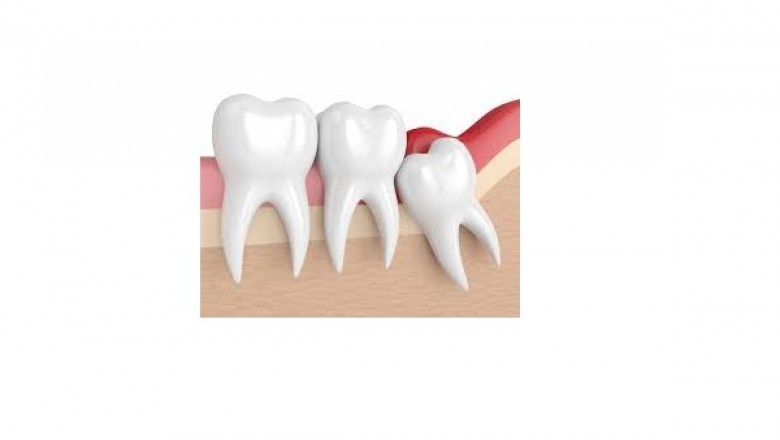 Why is it Essential to Remove the Wisdom Teeth?