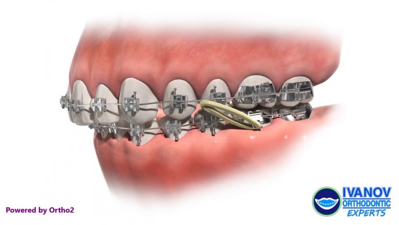 Can You Get A Perfect Smile With Invisalign?