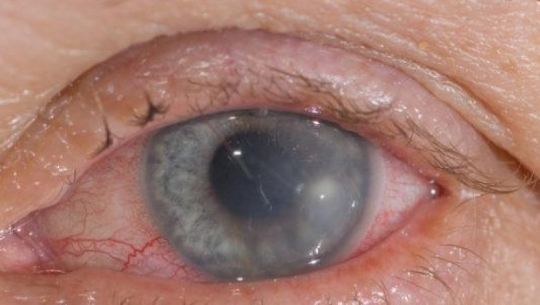 WHY CONTACT LENS WEARERS ARE AT A HIGHER RISK FOR CORNEAL ULCERS