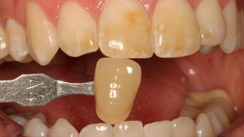 Required Teeth Whitening: What Can Be The Options?