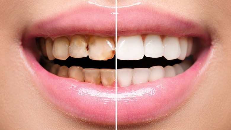 Why You Should See A Prosthodontist?