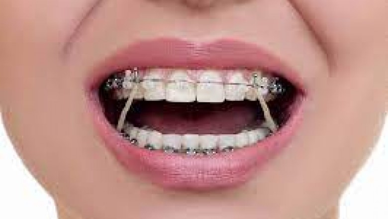 What You Should Know About Orthodontic Treatment?