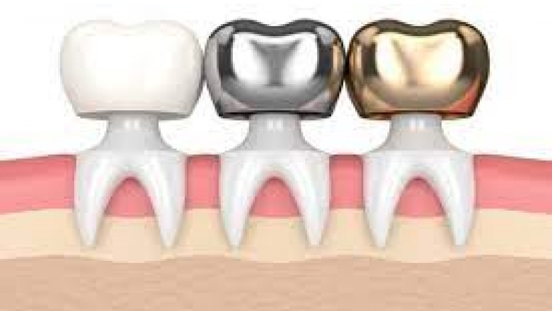 Dental Crown: What Are The Different Types?