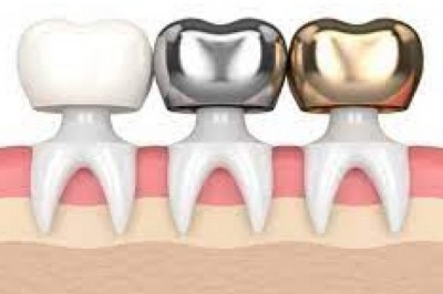 Dental Crown: What Are The Different Types?