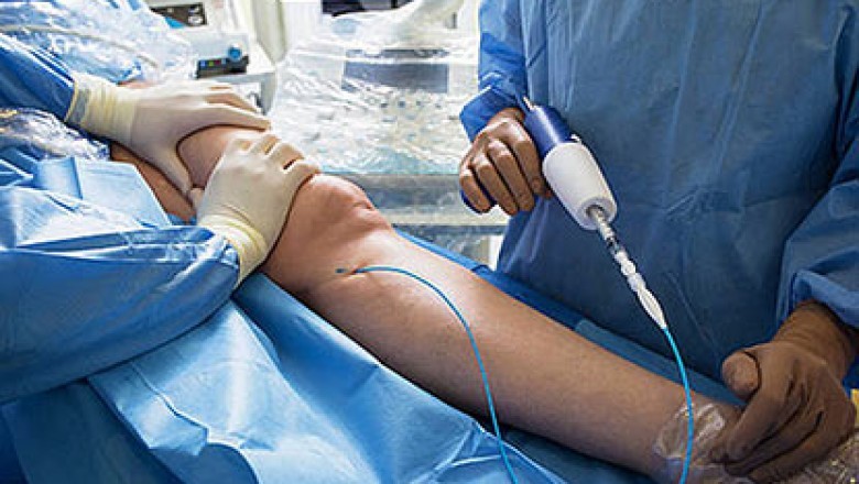 Five Best Methods For Spider Vein Treatments: