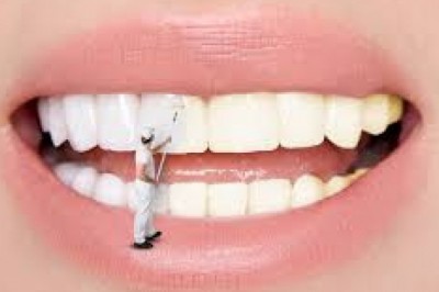 What are Porcelain Dental Veneers?