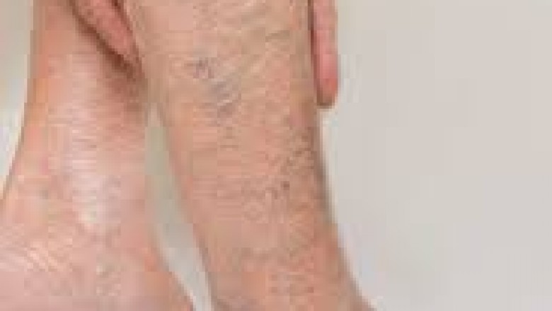 What you should know about the Varicose Veins?