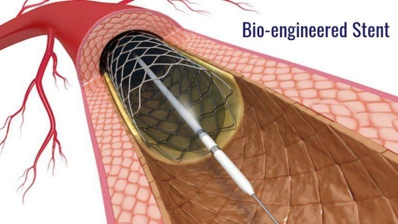 Bioengineered stents are a huge step forward in the medical field.