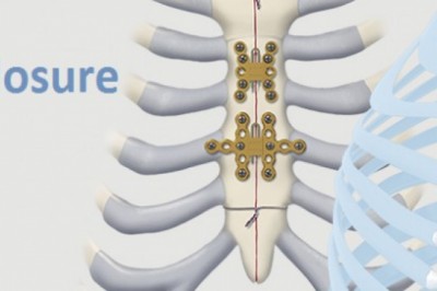 Sternal Closure Systems Market Size, Trends, Shares, Insights and Forecast – 2018-2026