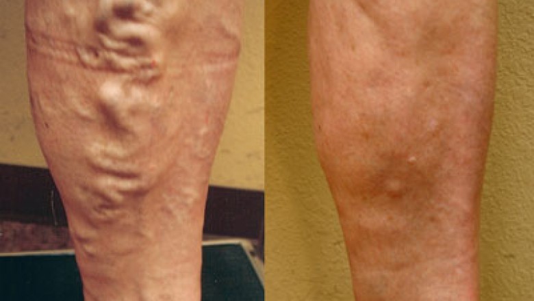 Harvard Trained Vein Doctor Woodland Park