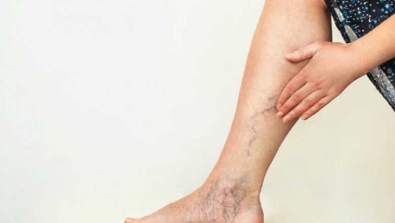 Treatment For Veins In California
