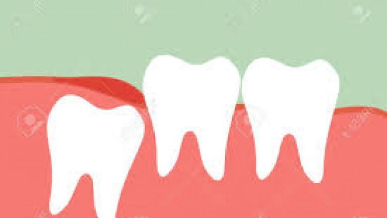 What Type of Dentures is Right for You?