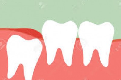 What Type of Dentures is Right for You?