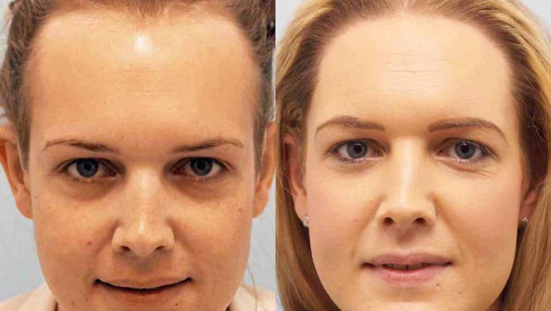 MTF and FTM Transgender Hair Transplant for Hair Loss