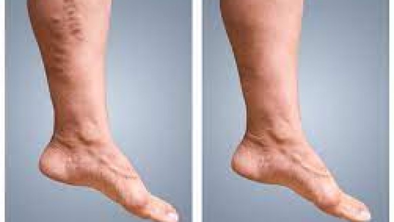Varicose Vein Treatment In San Diego