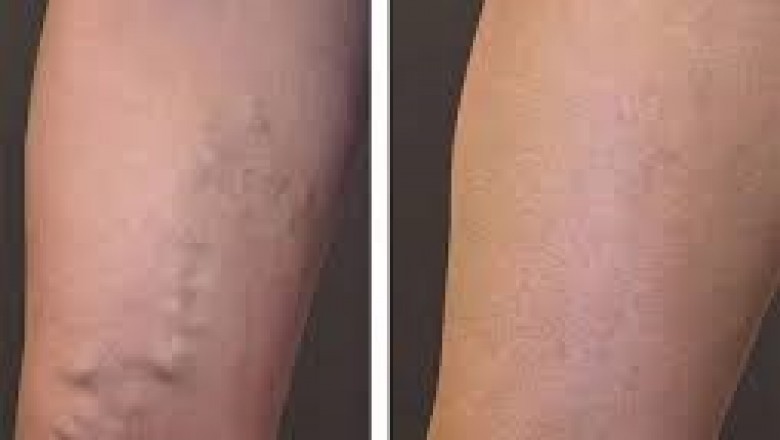 Who Requires To Get A Glimpse Of Vein Specialists?