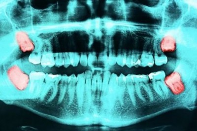 Cost of Crown Lengthening