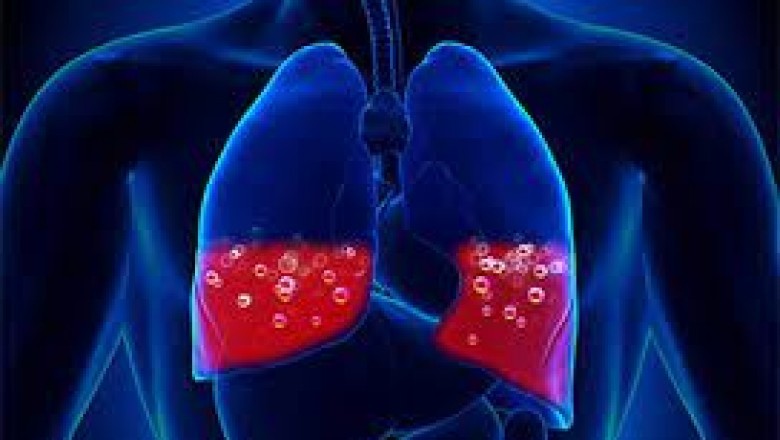 Pulmonary Edema Therapeutics Market Business Segmentation By Revenue And Structure Forecast 2027