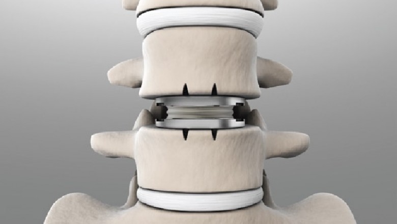 Patients who undergo Total Disc Replacement surgery typically go back to work a few days following the procedure