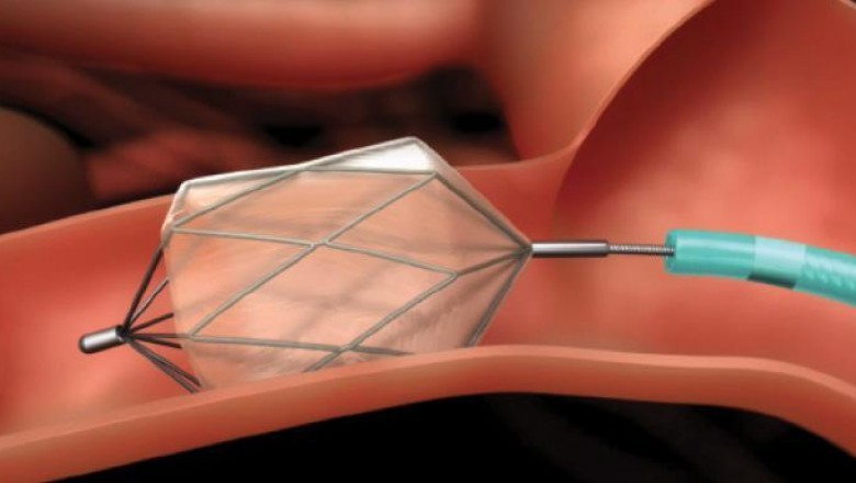 Transcatheter Embolization and Occlusion Devices are suitable for most patients suffering from various conditions like varicose veins, spider veins, varicose or leg ulcers, etc