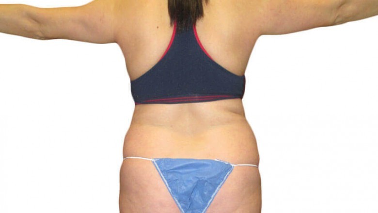 Liposculpture VS Liposuction: Which One Is The Finest For The Body