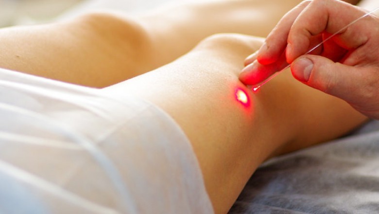 Vein Removal Treatment: Which One Is The Best For you?