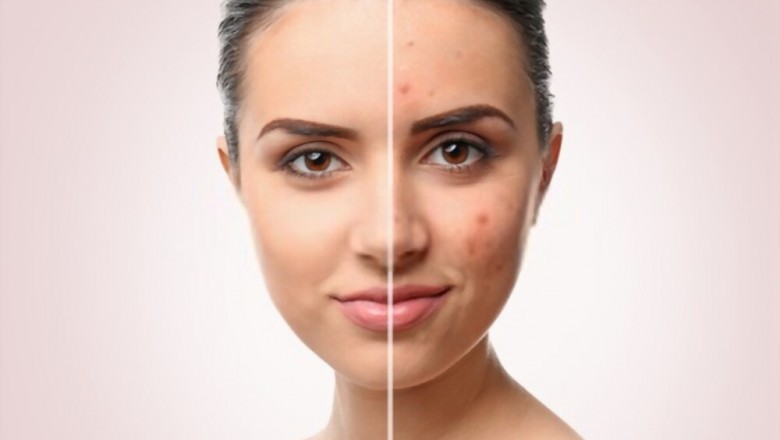 Acne Vulgaris Treatment - Why Herbal Medicines are Best Treatment For Acne Vulgaris