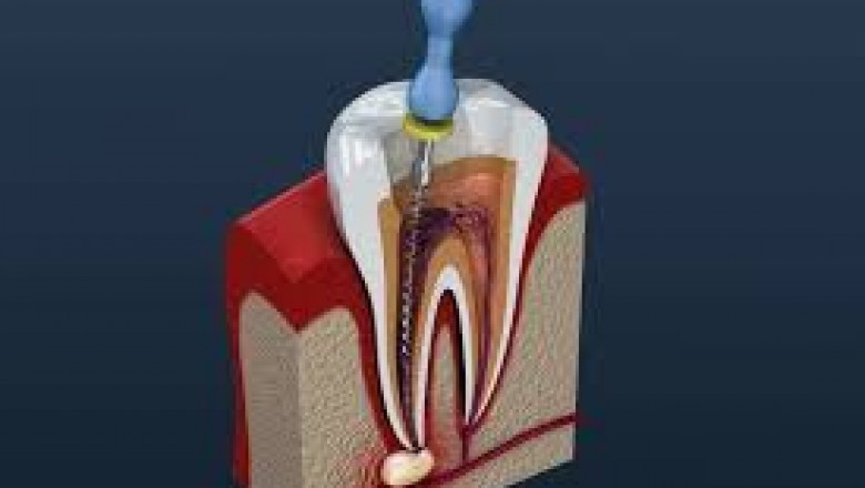 Root Canal in Houston, TX