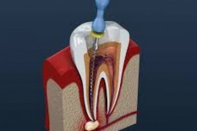 Root Canal in Houston, TX