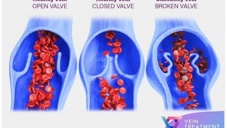 Six Risk Factors For The Growth Of Varicose Or Spider Veins.