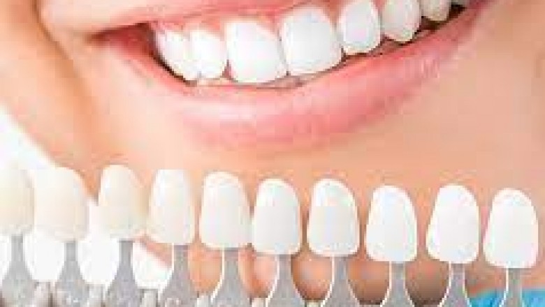 What is Full Mouth Reconstruction?